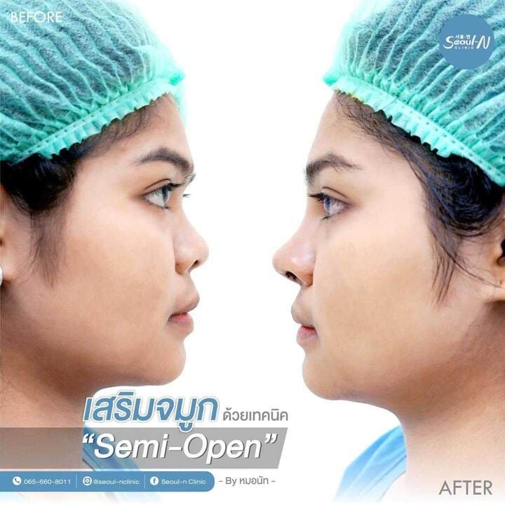 รีวิวเสริมจมูก Semi Open