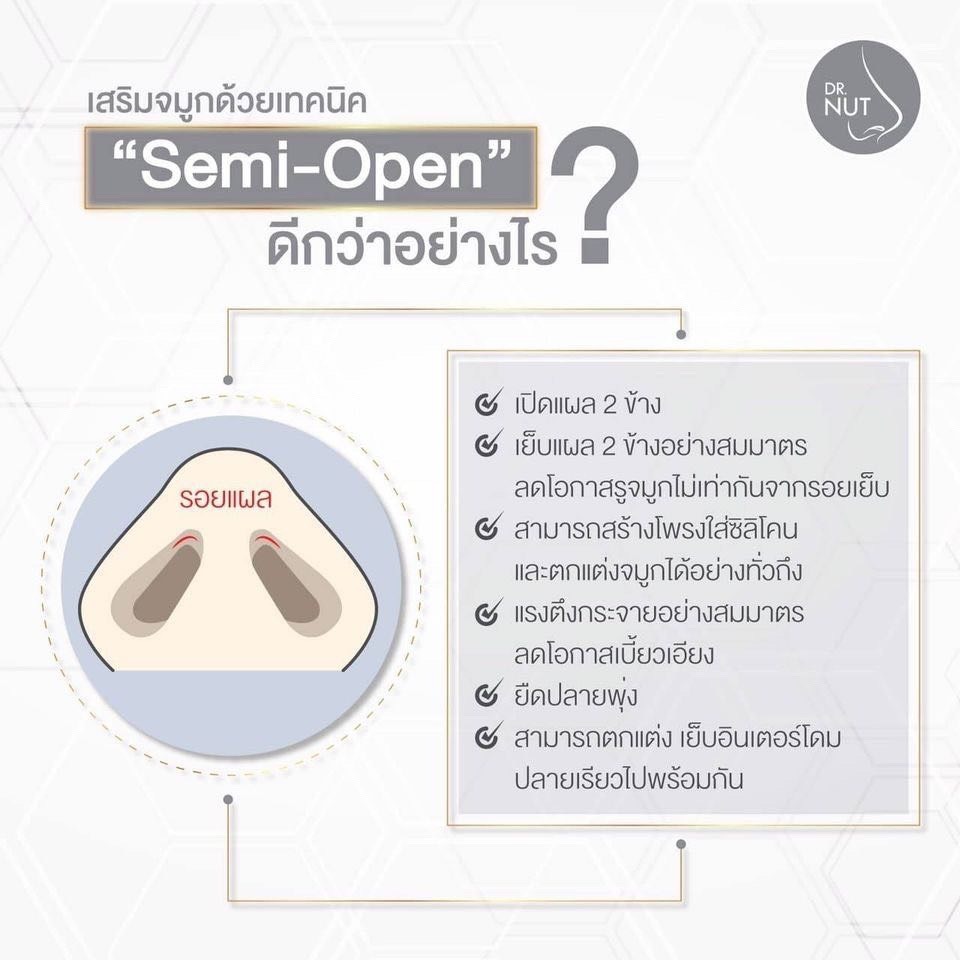 เสริมจมูก Semi Open