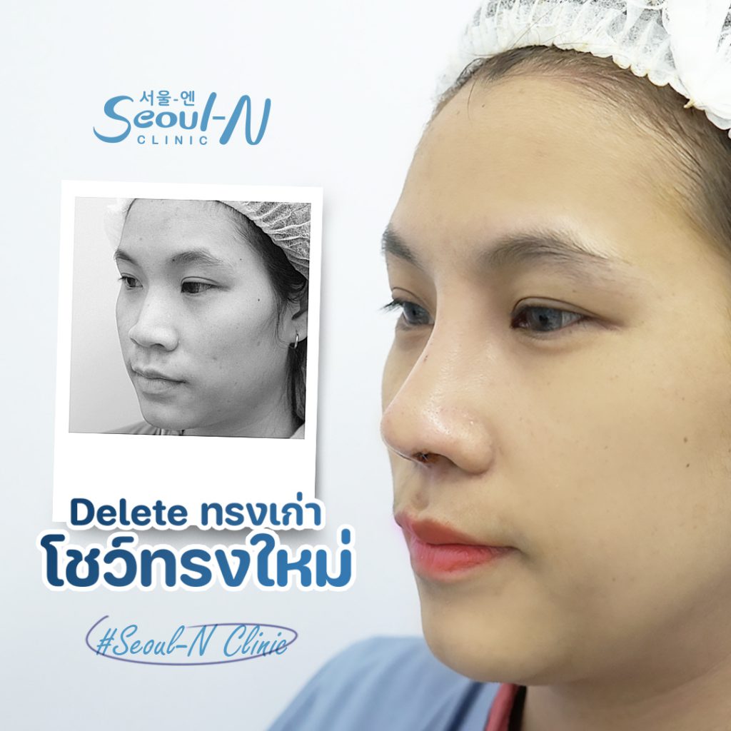 เสริมจมูก แก้จมูก Seoul-N Clinic