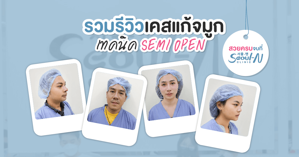 รวมรีวิวเคสแก้จมูก เทคนิค Semi open สวยครบ จบที่ Seoul-N Clinic