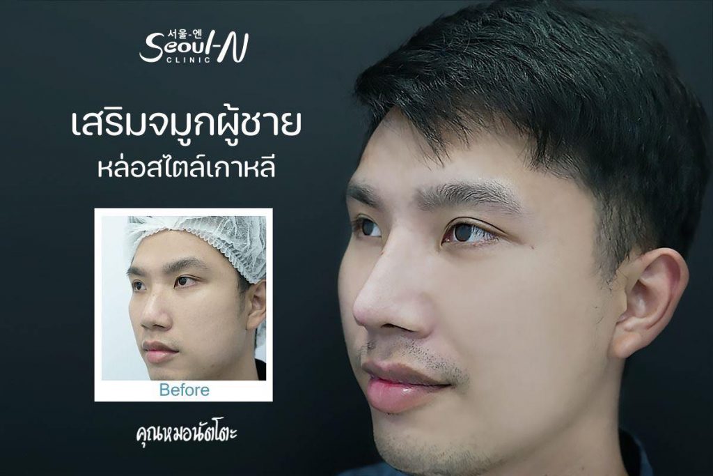 เสริมจมูกผู้ชาย