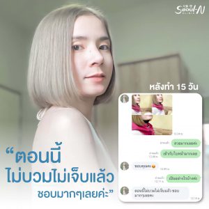 รีวิวเสริมจมูก Seoul N Clinic