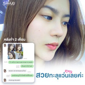 รีวิวเสริมจมูก Seoul N Clinic