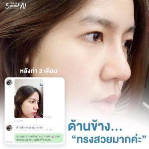 รีวิวเสริมจมูก Seoul N Clinic