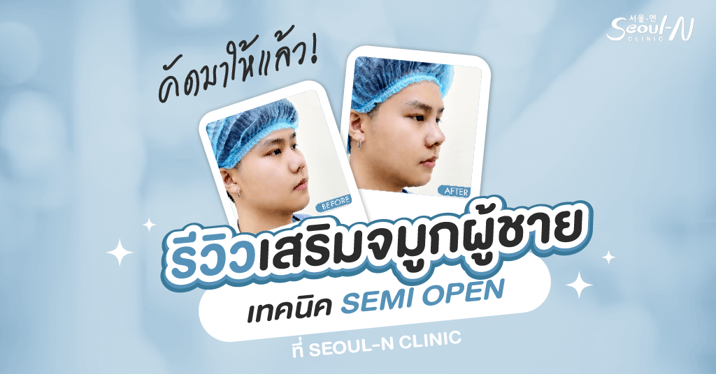 รีวิวเสริมจมูกผู้ชาย Seoul-N Clinic